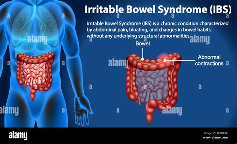 Irritable Bowel Syndrome Ibs Infographic Illustration Stock Vector