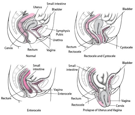 Overview Of Pelvic Organ Prolapse Pop Gynecology And Obstetrics