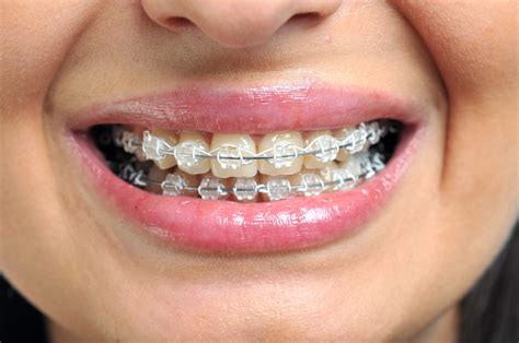 Understanding Metal Braces For Orthodontic Treatment