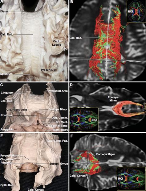Corpus Callosum | Neuroanatomy | The Neurosurgical Atlas, by Aaron ...
