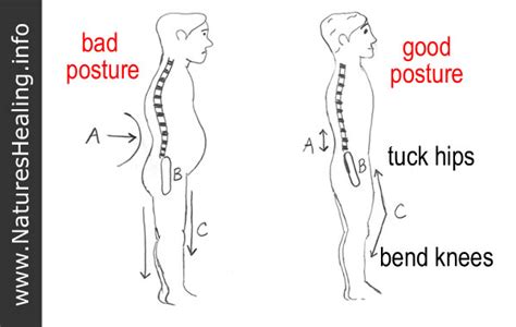Posture And Low Back Pain Natures Healing