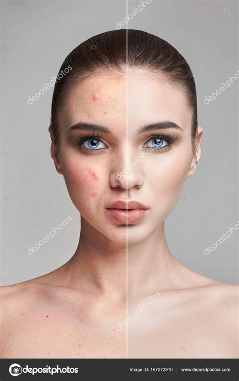 Pimples And Acne On The Womans Face Before And After Cosmetics To