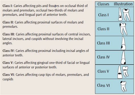 Caries Classification Dimensions Of Dental Hygiene Magazine