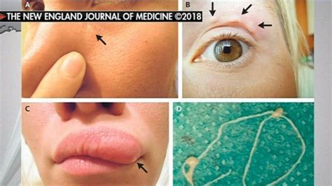 Doctors Discover Worm Underneath Skin On Womans Lip After Mosquito Bite