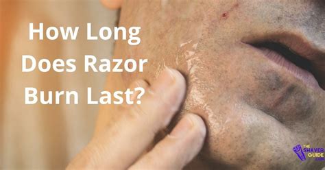 How Long Does Razor Burn Last Causes And Treatment The Shaver Guide