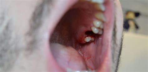 Blood Clot After Tooth Extraction 8 Of Your Most Faqs Az Dentist