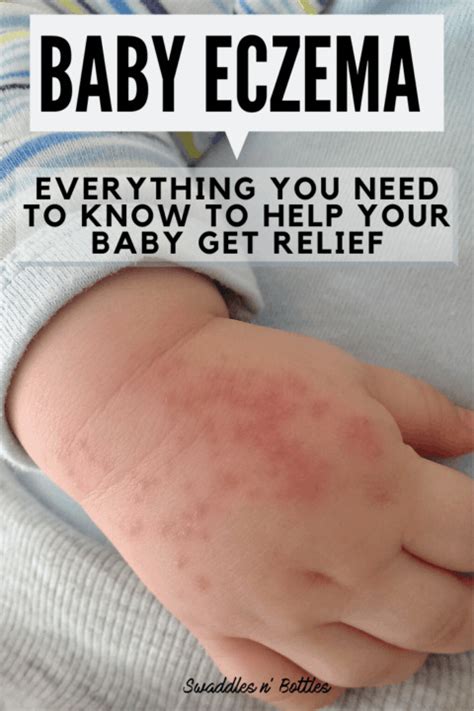 Baby Eczema Causes And Remedies Swaddles N Bottles