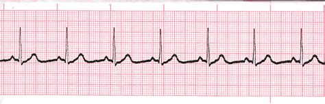 Atrial Tachycardia