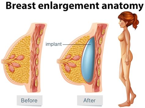 Een Menselijke Anatomie Van Het Borstimplantaat Premium Vector