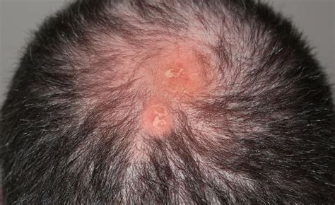 Folliculitis Decalvans Therapie Gegen Haarausfall Möglich Elithair