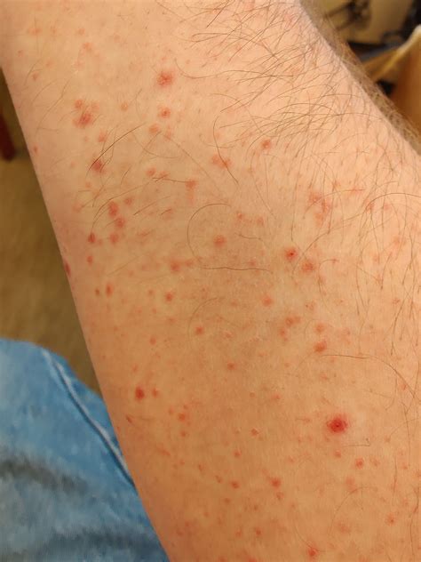 Got This Red Spots On My Arms About 10 12 Days Ago They Dont Itch