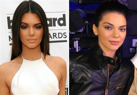 Kendall Jenner Before And After See The Pics That Have Fans Speculating Plastic Surgery