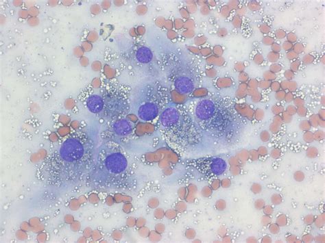 Leydig Cell Tumour Case Study Cytopath