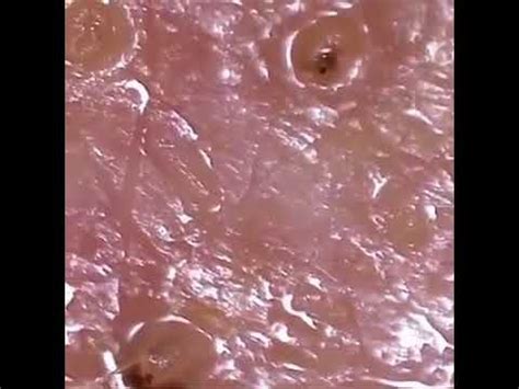 Types and species of mites that can irritate or paratize humans: Look at this Demodex mite moving on the surface of the ...
