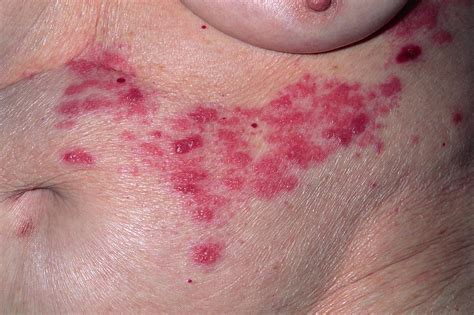 Shingles Rash On The Face Photograph By Dr P Marazzi Science Photo