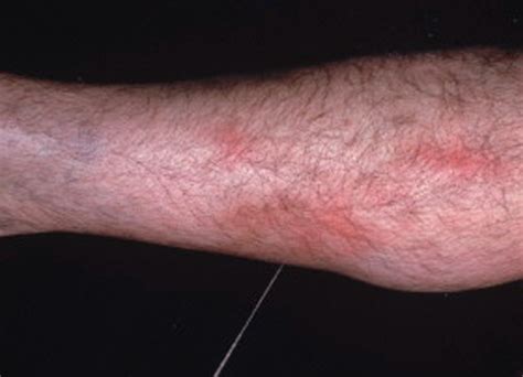 Thrombophlebitis Pictures 2