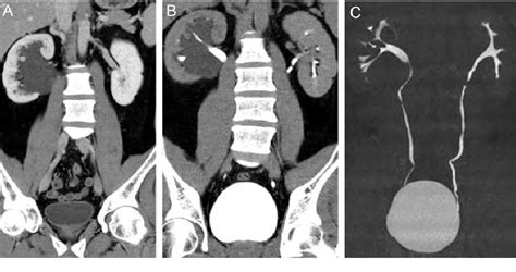Figure 2 From Parapelvic Cyst Misdiagnosed As Hydronephrosis Semantic