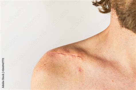 Scar On The Of A Male Body After Surgery On A Broken Collarbone