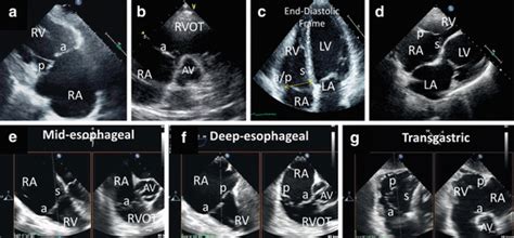 Tricuspid Valve Interventions Heart Team Discussion When Who And