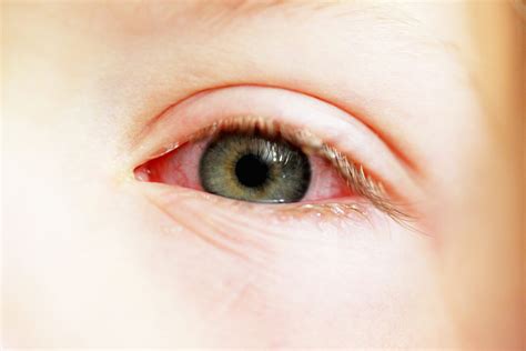 More Than Half Of Children With Vernal Keratoconjunctivitis Likely Have