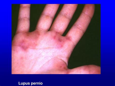 Ppt Systemic Lupus Erythematosus Sle Powerpoint Presentation Free