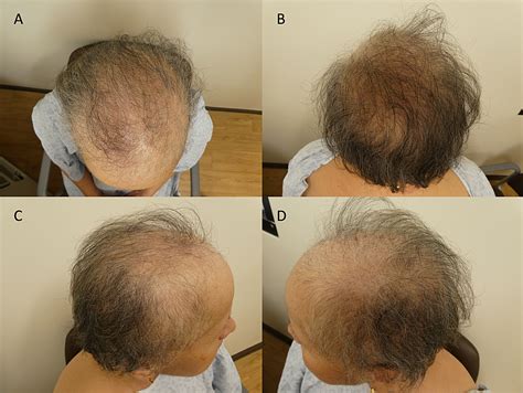 Chemo Hair Loss Scalp Care Scalp Pustules In A Patient Receiving