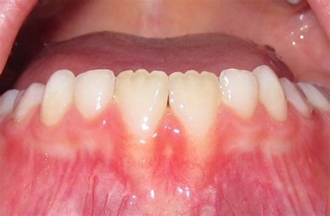 Mamelons The Bumps On Your Childs Permanent Teeth Are Normal Oral