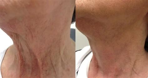 Facetite And Necktite Non Surgical Jowl And Neck Tightening