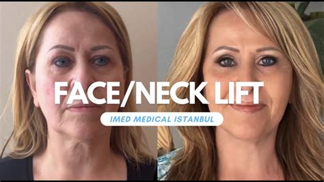 Face And Neck Lift By Imed Medical Istanbul Youtube