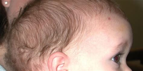 Dolichocephaly Definition Pictures Symptoms Causes Treatment