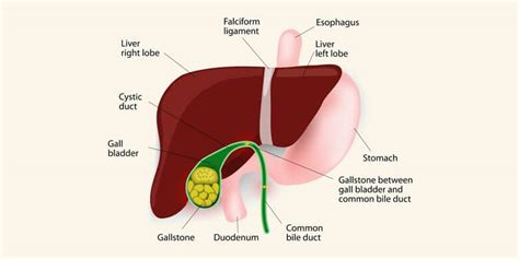 Common Gallbladder Diseases Prnso