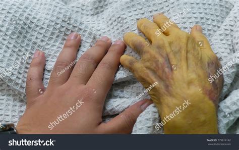 Jaundice Yellowish Discoloration Sclera Skin Stock Photo 779814142