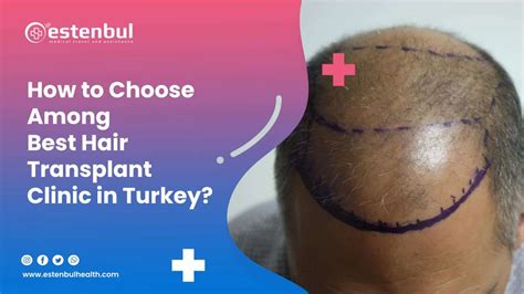 How To Choose Among Best Hair Transplant Clinic In Turkey Estenbul