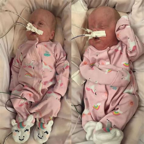 Identical Micro Preemie Twin Girls Among Youngest Babies To Be Born At