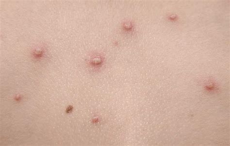 Molluscum Contagiosum Know More About This Common And Really