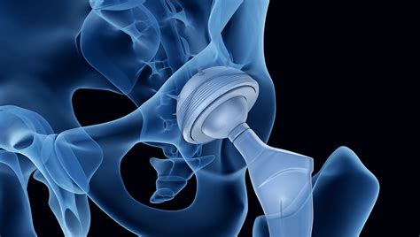 Hip Replacement Surgery 30 Year Advancements Orthopaedic Institute