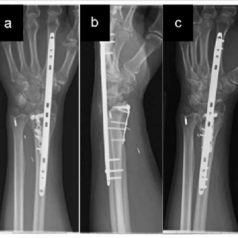 Plain Radiographs Of The Left Wrist Following Operative Fixation A