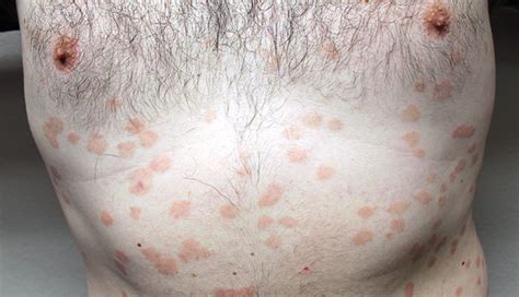 Pictures Of A Rash From Strep Throat Picturemeta