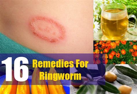 Home Remedies For Ringworm Natural Cure And Treatments For Ringworm