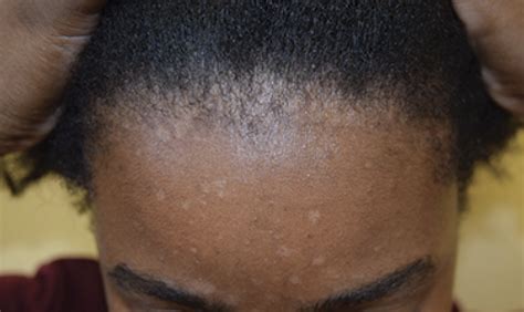Seborrheic Dermatitis Of The Face And Scalp In Skin Of Color Clinical