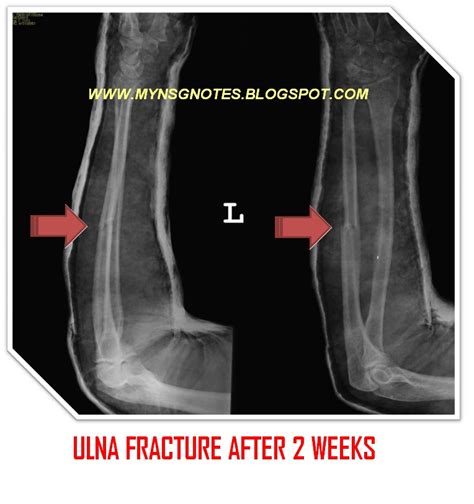 My Nurses Notes Ulna Fracture After 2 Weeks