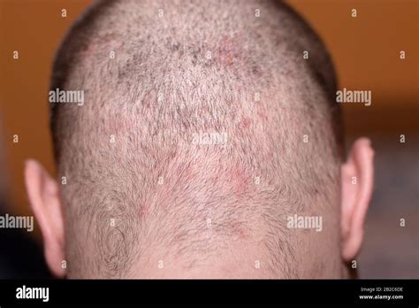 Back View Of A Bald Mans Head With Short Hair Suffering From Scalp
