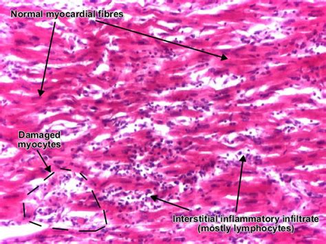 A position statement of the european society of cardiology working group on myocardial and pericardial diseases. Myocarditis. Causes, symptoms, treatment Myocarditis