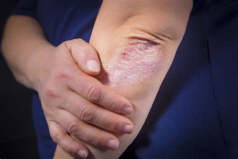 Psoriasis Des Coudes Et Genoux Que Faire