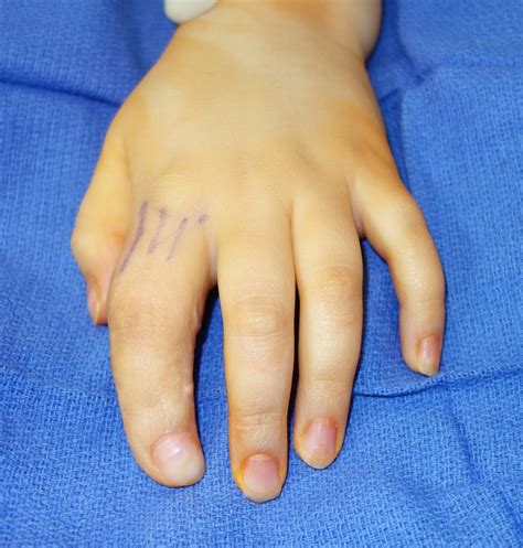 Macrodactyly Large Digits Congenital Hand And Arm Differences