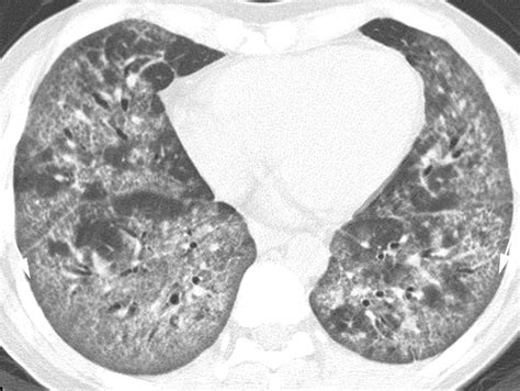 Challenges In Pulmonary Fibrosis · 1 Use Of High Resolution Ct