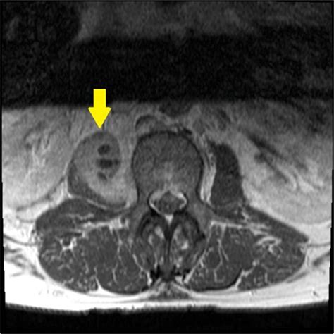Axial T1 Weighted Mri Shows Multiloculated Rim Enhancing Abscess In The
