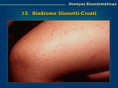 Papular Acrodermatitis Of Childhood Treatment Guideline White Patches