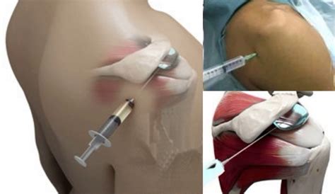 Fig A Subacromial Injection Cambridge Shoulder