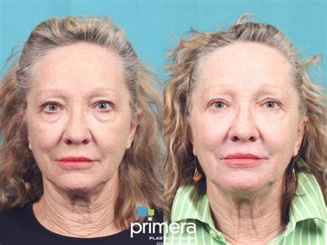 Chemical Peel Before And After Photo Gallery Orlando Florida